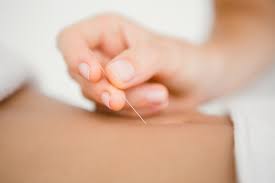 Dry Needling for Female Conditions: An In-Depth Look